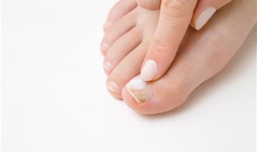 How to Treat a Damaged Toenail Safely at Home